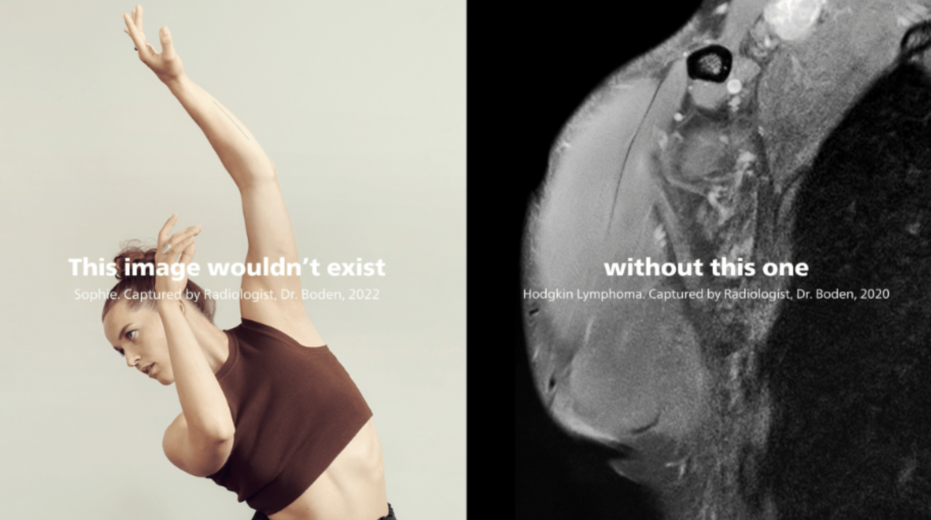 Side by side images. On the right is a portrait photo of a woman bending over to the side. On the left is an x-ray photo of the woman's shoulder.